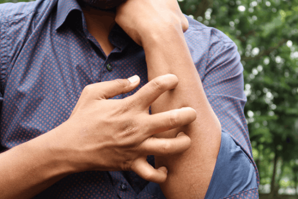 DWP Confirmed Twenty Five Skin Conditions Eligible for Weekly Benefit